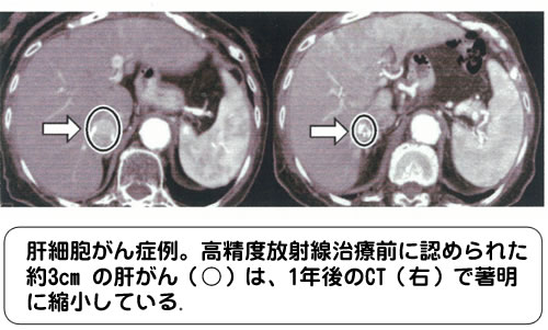 肝がん