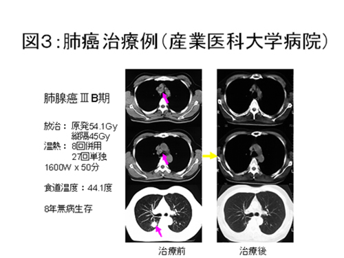 肺がん治療例