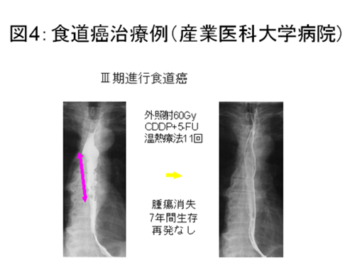 食道がん治療例