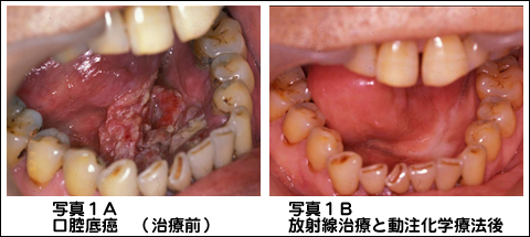 口腔底癌