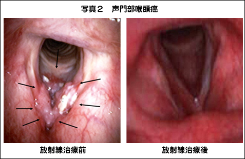 声門部喉頭癌