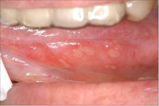 口内炎 カンジダ 性 口内炎の種類～種類ごとの症状、原因、できやすい場所とは？～