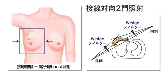図1A 対向2門照射による全乳房照射。