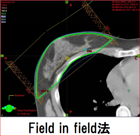 図１Ｂ.従来方法の一般的ンな接戦照射の問題点とそれをカバーするために照射野を複数組み合わせて行う工夫(field in field 法)：一般的な接線照射では広島市民病院放射線治療科にいらした竹内有紀先生ご作成。
