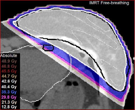 図２Ｂ　IMRT機(左)と Tomotherapy(右)を比較すると、TomotherapyのほうがLADを避けられている。