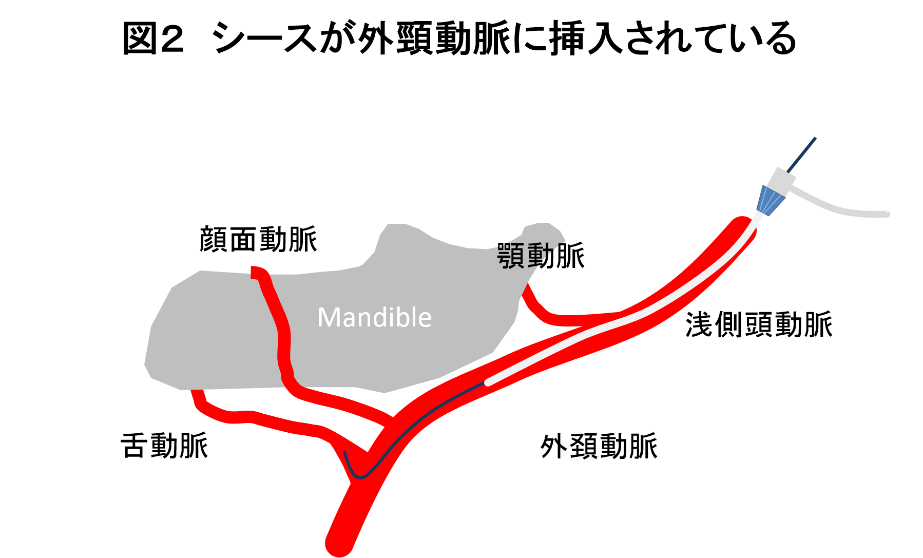 図２ シースが外頸動脈に挿入されている