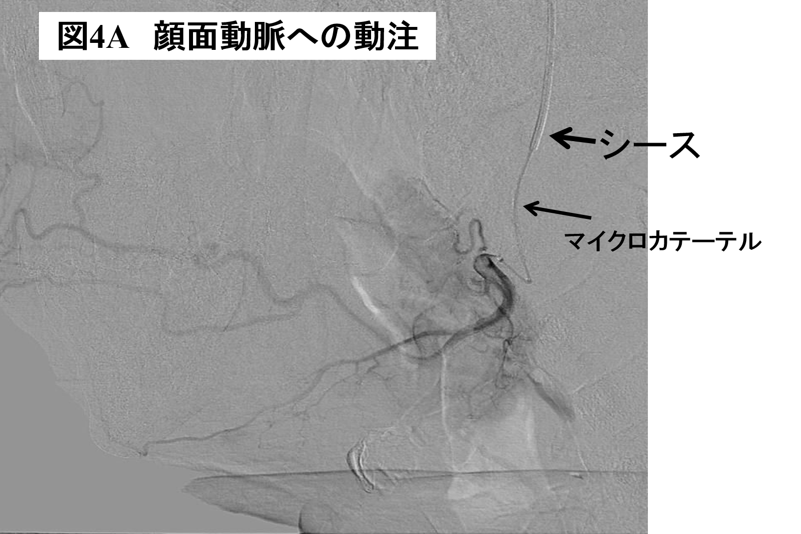 図4A 顔面動脈への動注