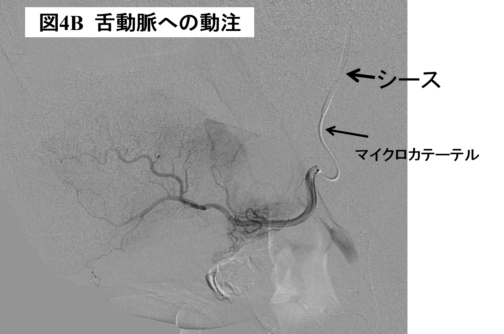 図4B 舌動脈への動注