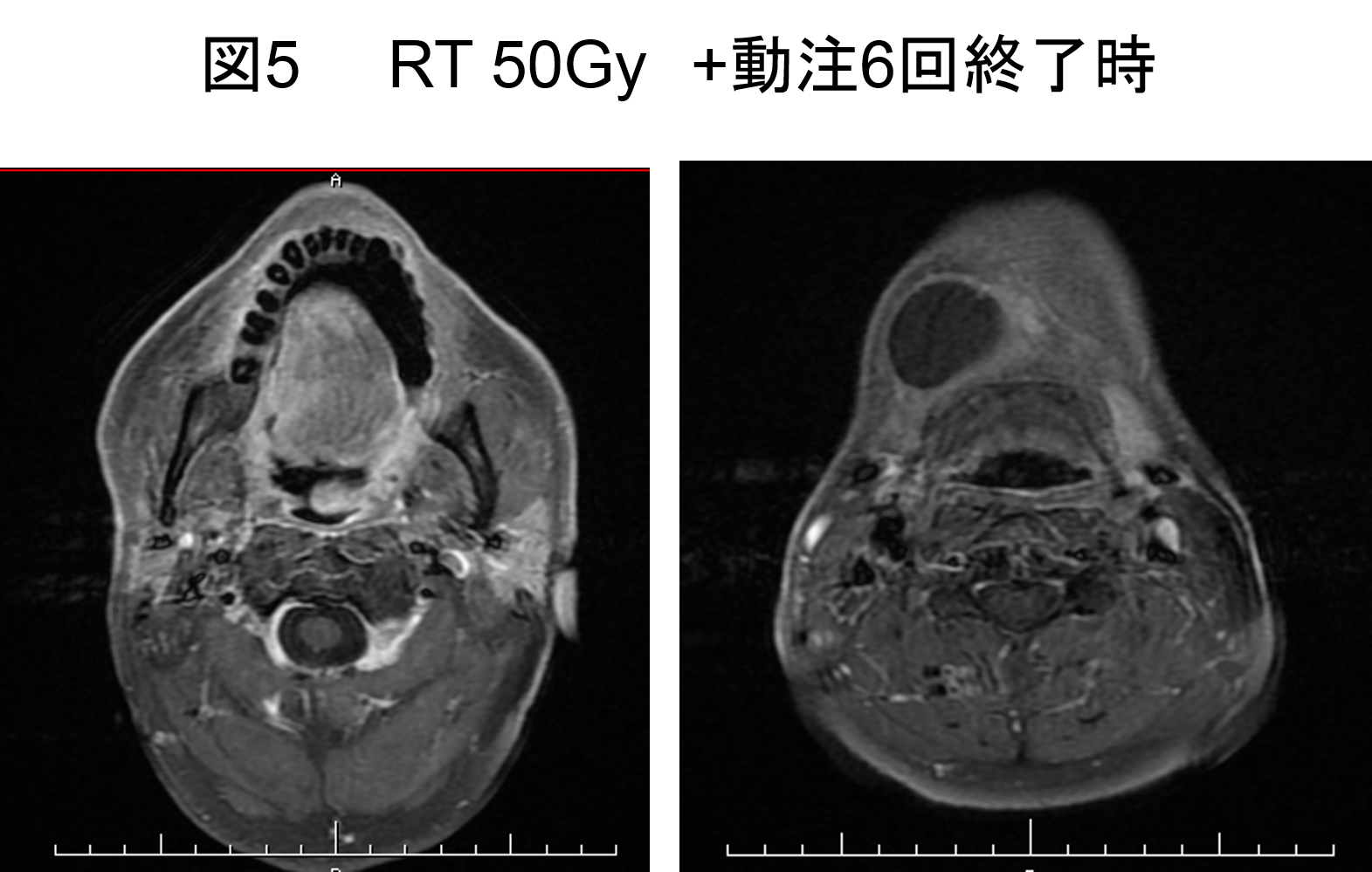 図5 RT 50Gy　+動注6回終了時