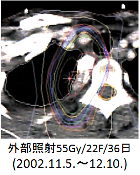 図2 外部照射の線量分布