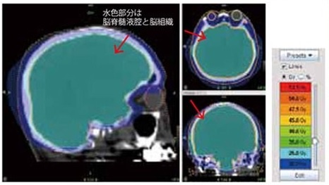 図１Ｂトモセラピーでの全脳照射