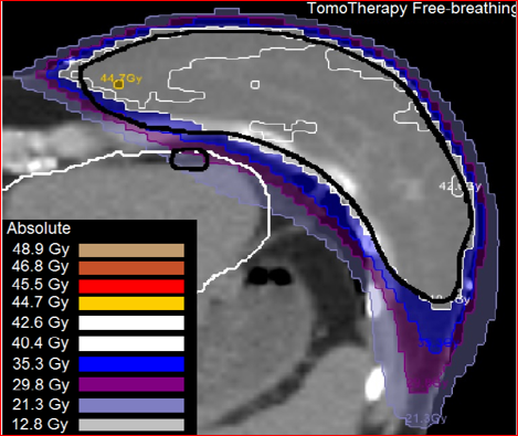 図２Ｂ　IMRT機(左)と Tomotherapy(右)を比較すると、TomotherapyのほうがLADを避けられている。