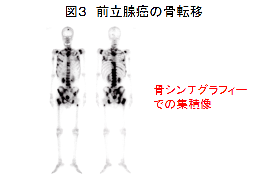 図3 前立腺癌の骨転移