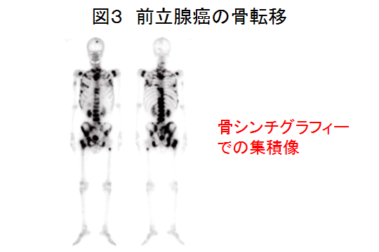 図３ 前立腺癌の骨転移