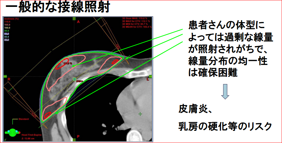 図1B.従来方法の一般的ンな接戦照射の問題点とそれをカバーするために照射野を複数組み合わせて行う工夫(field in field 法):一般的な接線照射では広島市民病院放射線治療科にいらした竹内有紀先生ご作成。